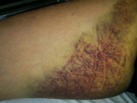 40代,前半,心筋梗塞,体験,ピエール